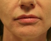 Filler Gel for Smile Lines Around Lips - after