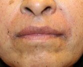 Restylane Into Creases Around Lips - after
