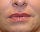 Fine Lines Fine Lip Wrinkles - before