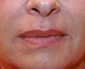 Fine Lines Fine Lip Wrinkles - after