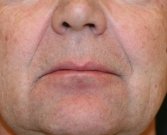 Smile Lines Filling - before