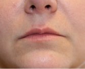 Plump Lips and Turn Up Corners of Lips - before