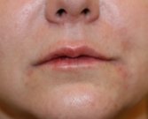 Plump Lips and Turn Up Corners of Lips - after