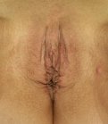 labia-plasty-vaginal-skin-reduction - after