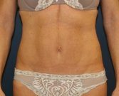 Mini-Tummy-Tuck-San-Diego - after