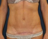 Mini-Tummy-Tuck-Scar-San-Diego - after