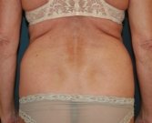 Liposuction Waist, Mini-Tummy Tuck - before