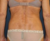 Liposuction Waist, Mini-Tummy Tuck - after