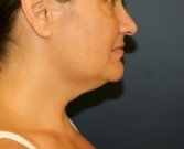 Necklift by liposuction - before