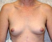 Breast Augmentation Case 9 - before