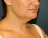 Neck-Lift by Liposuction - before