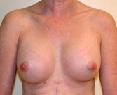 Breast Augmentation Case 9 - after