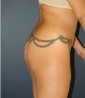 Lipo Flanks & Thighs, Fat to Buttocks - before