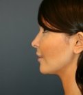 Implant at Base of Nose - after