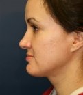 Implant Base of Nose Top of Nose - before