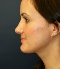 Implant Base of Nose Top of Nose - after