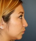 Feminizing Rhinoplasty 56 - before