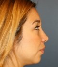 Feminizing Rhinoplasty 56 - after