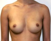 Breast Augmentation Case 10 - before