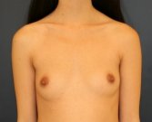 Natural Breast Augmentation 6 - before