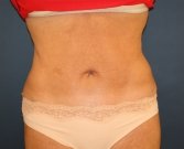 Tummy-Tuck-San-Diego-Revision-90 - after