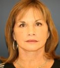 Anti-Aging Intervention (face-neck) - after
