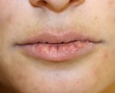 Lip Augmentation with Restylane Defyne - before
