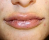 Lip Augmentation with Restylane Defyne - after