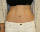 Tummy-Tuck-San-Diego-91 - after