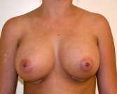 Breast Augmentation Case 11 - after