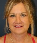 Comprehensive Facial Rejuvenation - after