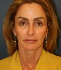 Preventive Facial Rejuvenation - before