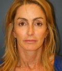 Preventive Facial Rejuvenation - after