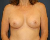 Proportionate Breast Augmentation - after