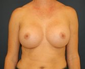 Breast Augmentation San Diego 550 cc - after