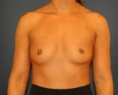 Breast Augmentation San Diego 400 cc - before