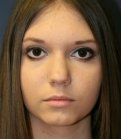 Rhinoplasty (for smaller nose) - before