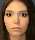 Rhinoplasty (for smaller nose) - after