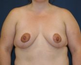 Breasts Uplifted San Diego - after