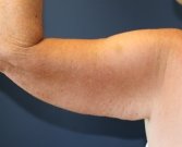 Left Arm Lift San Diego after weight loss - before
