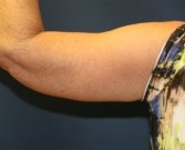 Left Arm Lift San Diego after weight loss - after