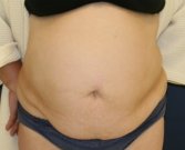 Tummy-Tuck-for-hanging-skin - before