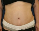 Tummy-Tuck-for-hanging-skin - after