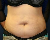 Tummy-Tuck-Vietnam-San-Diego - before