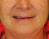 Lip Lift (naturally asymmetric) - before