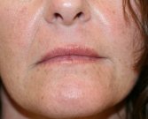 Upper Lip and Corner of Lip Lift - before