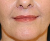 Upper Lip and Corner of Lip Lift - after