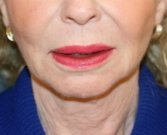 Jowl Removal (non-surgical facelift) - before