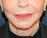 Jowl Removal (non-surgical facelift) - after