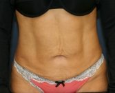 Tummy Tuck Loose Skin Only - before